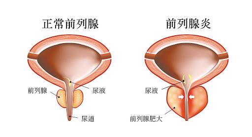 關(guān)于前列腺與性功能的關(guān)系，探究兩者之間的關(guān)聯(lián)與影響，前列腺與性功能關(guān)系探究，關(guān)聯(lián)與影響分析