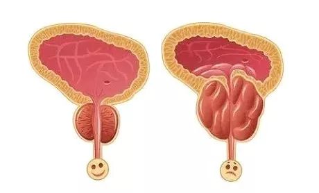 老公的前列腺增大挑戰(zhàn)，理解、支持與共同對抗，老公前列腺增大，理解、支持與共同應對的挑戰(zhàn)