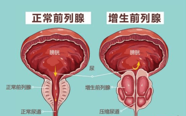 前列腺增生大小標(biāo)準(zhǔn)，理解其關(guān)鍵要素與影響，前列腺增生大小標(biāo)準(zhǔn)詳解，關(guān)鍵要素與影響因素解析