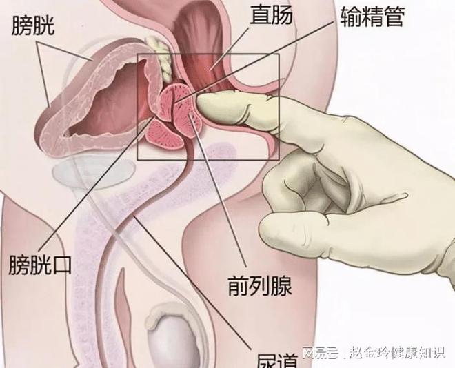 慢性前列腺炎，能否徹底治愈？解析與探討，慢性前列腺炎的治愈可能性解析與探討