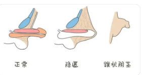 關(guān)于做包皮手術(shù)的費用分析，包皮手術(shù)費用詳解