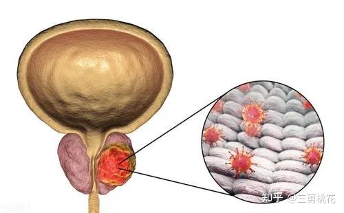 前列腺腫大如何消除，理解、預防與應對策略，前列腺腫大消除策略，理解、預防與應對方法