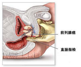 根治前列腺疾病的最佳中藥偏方，探尋古老智慧的新希望，古老智慧新希望，最佳中藥偏方根治前列腺疾病