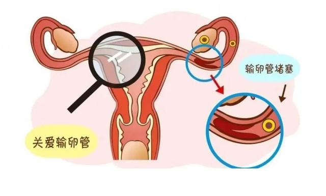 輸卵管堵塞的癥狀表現(xiàn)與解析，輸卵管堵塞的癥狀、表現(xiàn)與解析