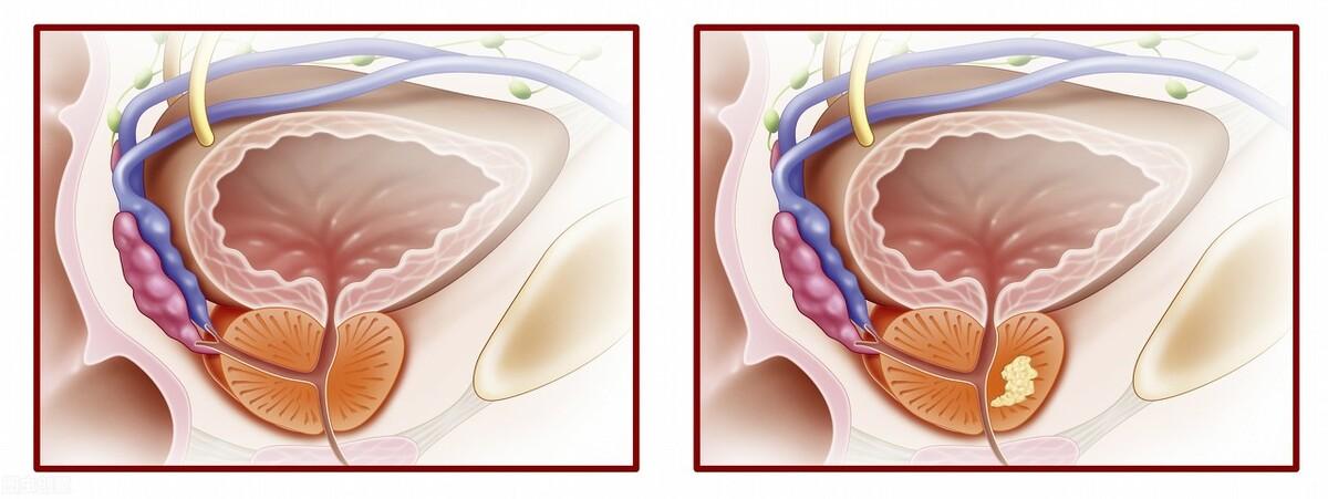 前列腺鈣化，揭示其潛在危害，前列腺鈣化，潛在危害揭秘