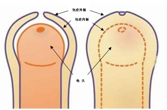 包莖及其相關(guān)圖片，了解、識別與處理，包莖詳解，圖片、識別、處理方法全攻略