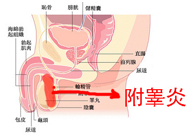 附睪炎，絕望中的希望曙光，附睪炎，絕望中的希望之光