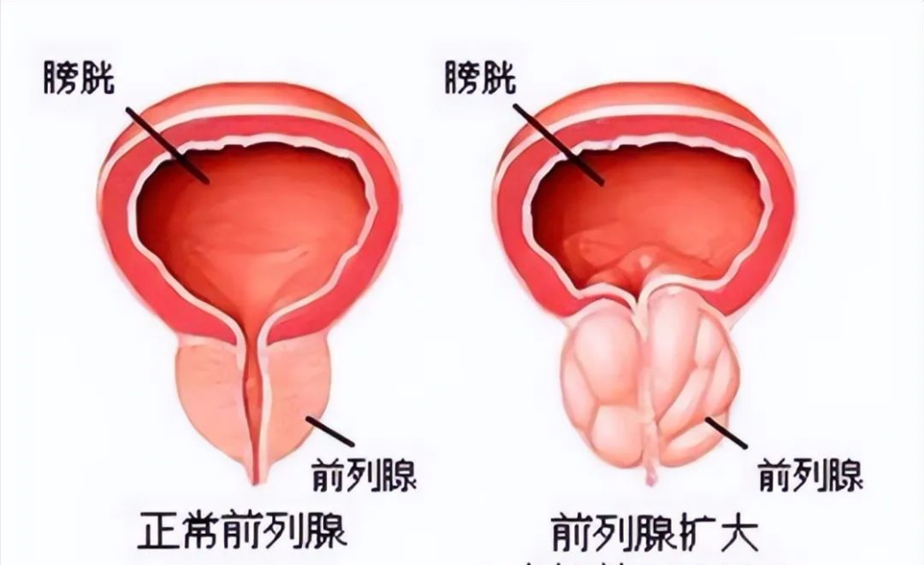 前列腺疾病的癥狀及其影響，前列腺疾病的癥狀及影響概述