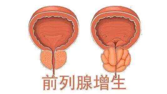 前列腺增生藥物治療效果評估與最佳用藥選擇，前列腺增生藥物治療效果評估及最佳用藥選擇探討