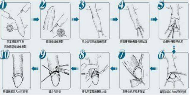 大人環(huán)切手術(shù)后的恢復(fù)圖及其相關(guān)解析，大人環(huán)切手術(shù)后的恢復(fù)圖詳解與解析