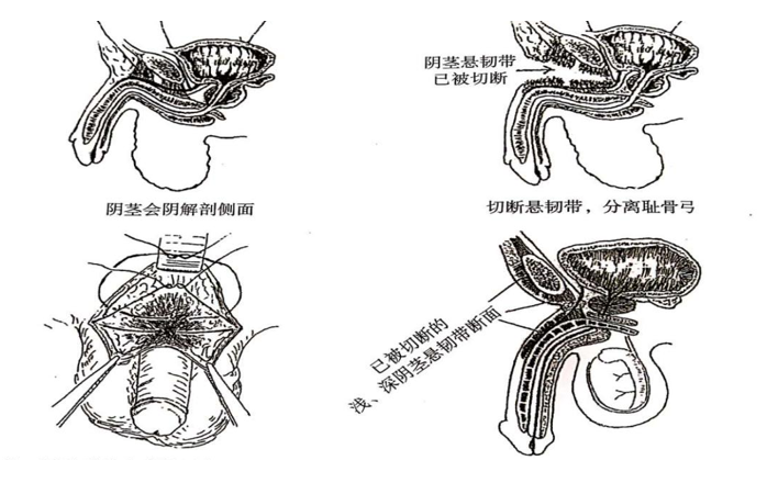 男性增大手術靠譜嗎？深度解析與探討，男性增大手術深度解析，可靠性與風險探討